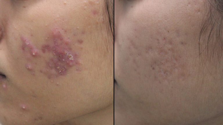 Acne-after-before